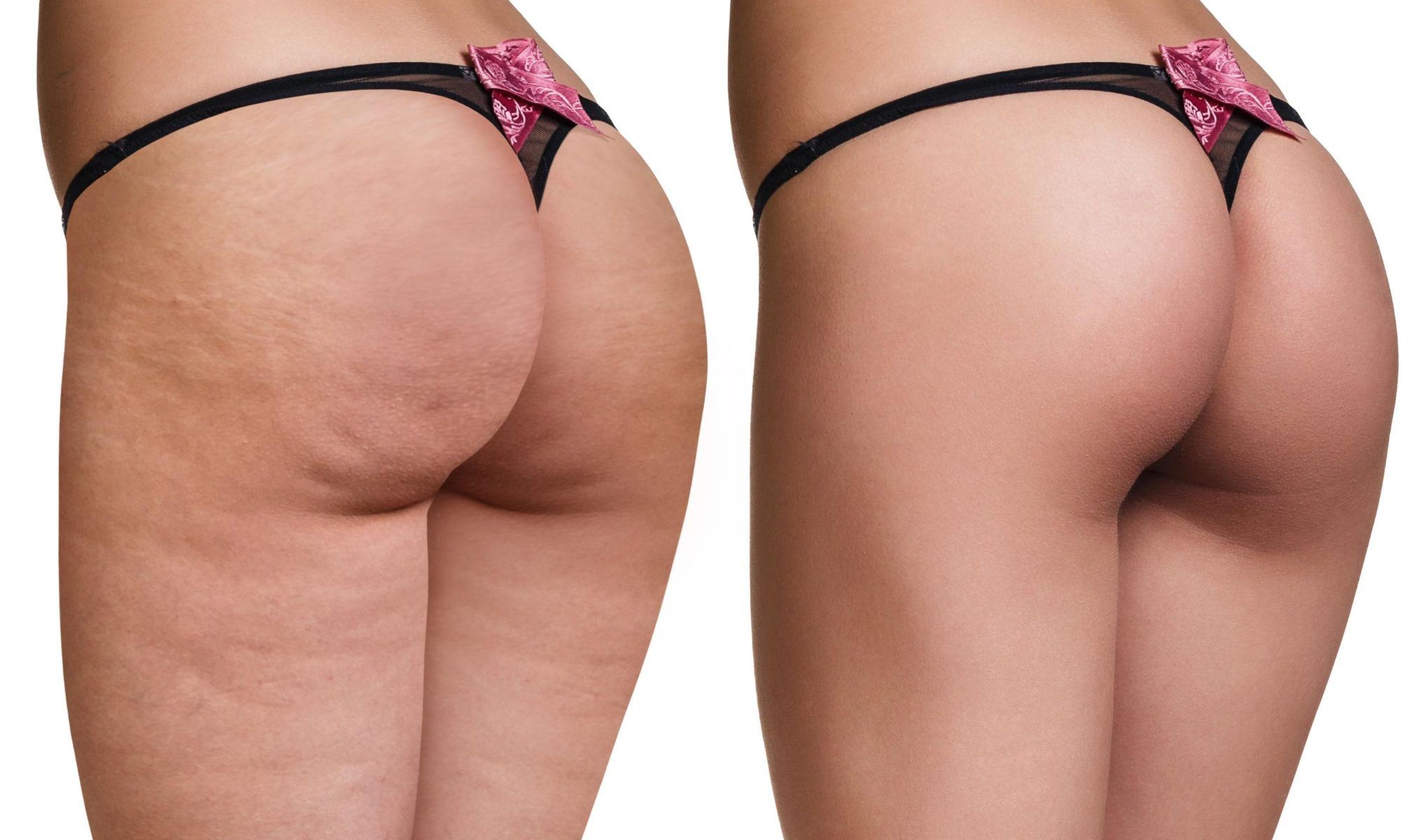 Selülit Giderici Yöntemler Nelerdir? Kesin Yöntemler! 1 selülit giderici tedaviler